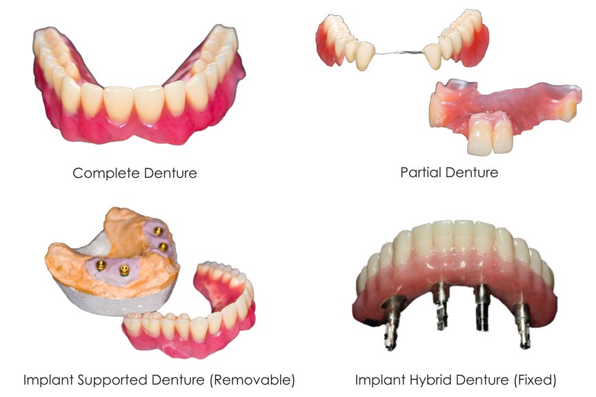 Types-of-Dentures